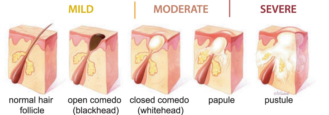 How Acne Forms